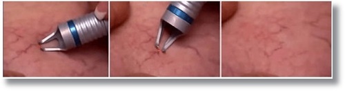 Laser Vascu Master - zamykanie naczyń krwionośnych