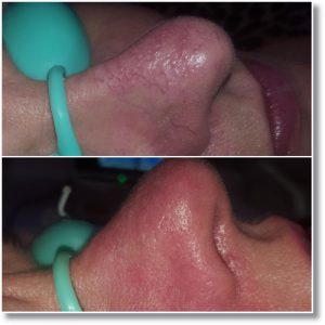 Laser Vascu Master - zamykanie naczyń krwionośnych