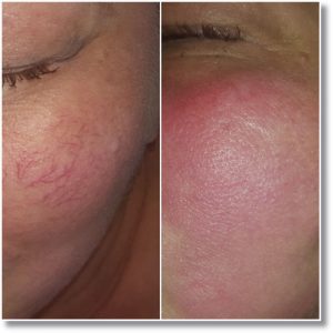 Laser Vascu Master - zamykanie naczyń krwionośnych