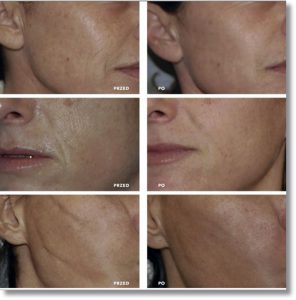 Linerase - regeneracja kolagenem