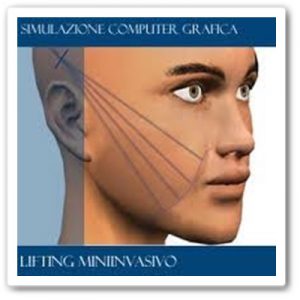 soft lifting - modelowanie twarzy kwasem hialuronowym